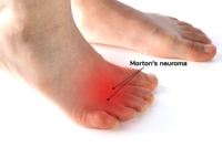 Diagnosis and Treatment of Morton’s Neuroma