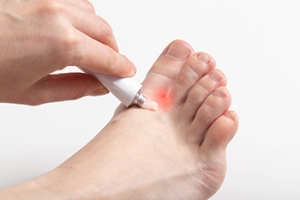 The Tinea Infection Known as Athlete’s Foot